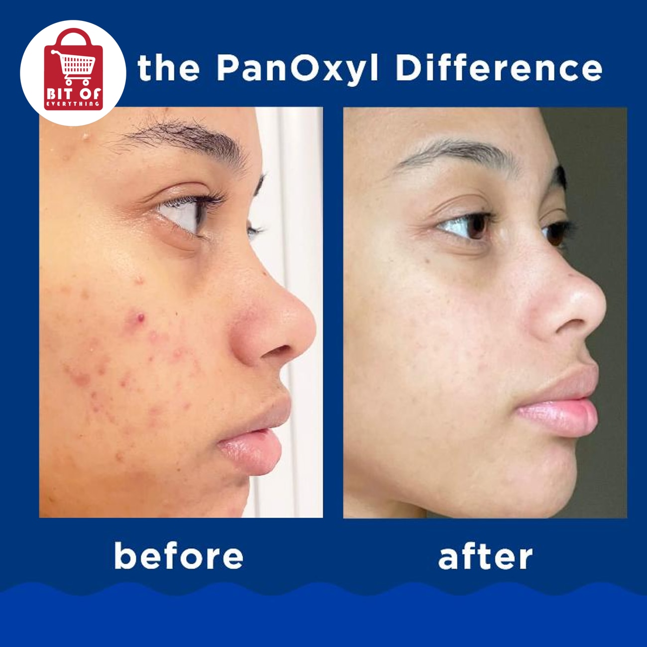 PanOxyl Face Wash – Acne Control Facial Cleanser for Deep Cleansing & Clearer-Looking Skin
